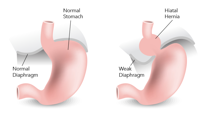 HIATAL HERNIA REPAIR